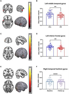 A longitudinal study of the brain structure network changes in HIV patients with ANI: combined VBM with SCN
